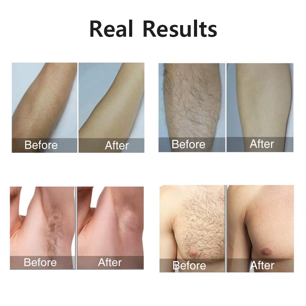 Revolutionary IPL Laser Hair Removal Device - 999,999 Flashes for Effortless and Permanent Hair Removal on Body and Bikini Area